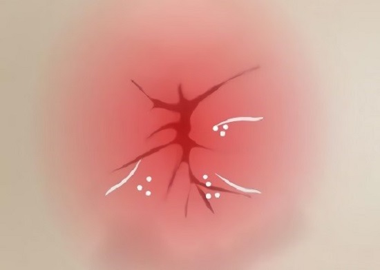 Зуд и жжение в ананальном отверстии у женщин и мужчин: причины и лечение