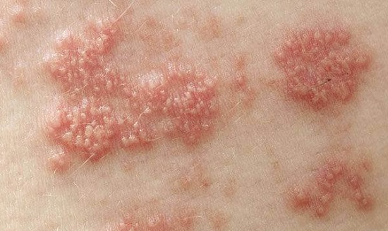 Зуд и жжение в ананальном отверстии у женщин и мужчин: причины и лечение