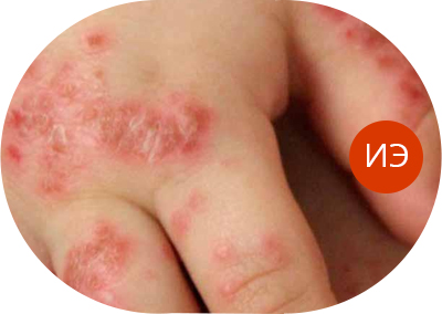 Почему чешется ладонь – внешние причины и болезни