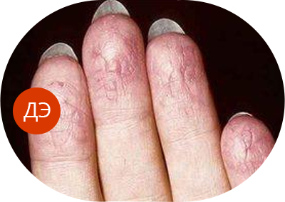 Почему чешется ладонь – внешние причины и болезни