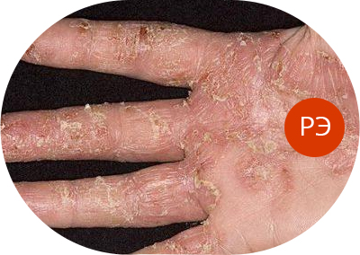 Почему чешется ладонь – внешние причины и болезни