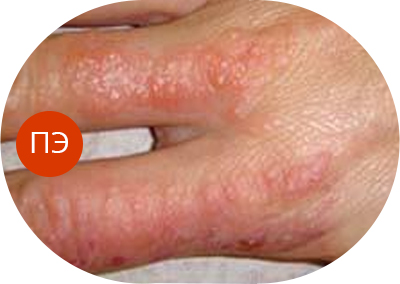 Почему чешется ладонь – внешние причины и болезни