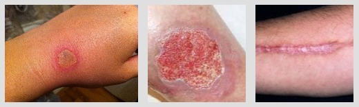 Грануляция раны и остальные фазы заживления травм