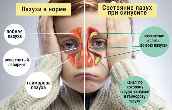 Желтая носовая жидкость при гайморите