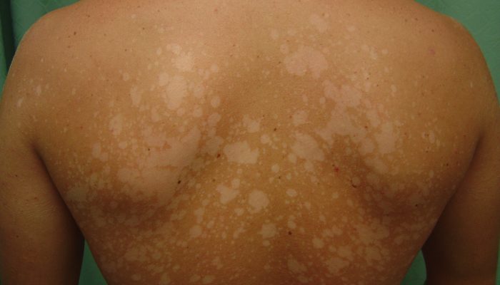 отрубевидный лишай