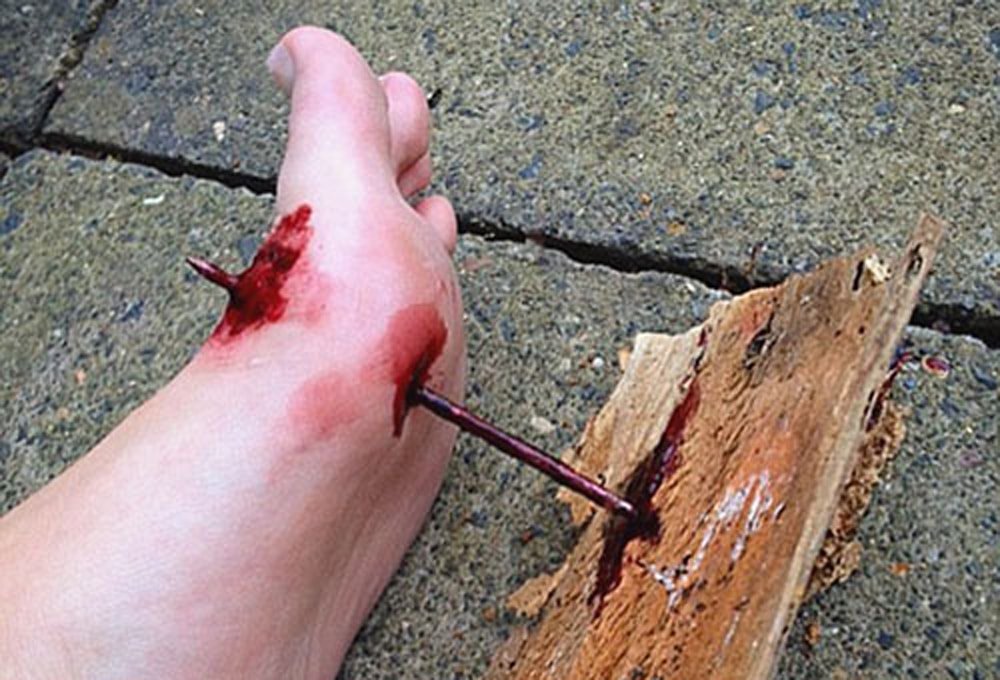 Гвоздь в ногу Ребенок наступил на гвоздь что делать