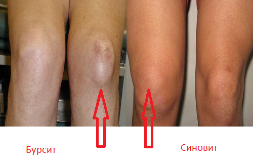 Бурсит или синовит
