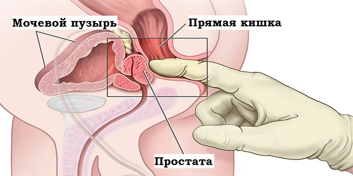 Массаж простаты