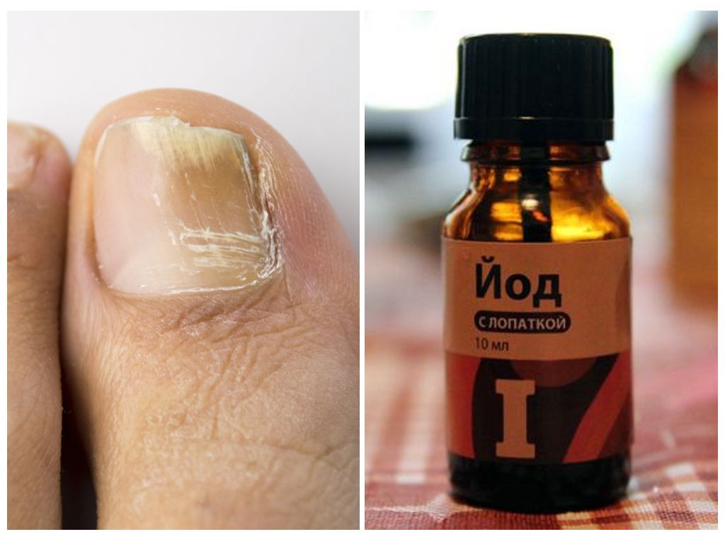 Лечение грибка ногтей йодом