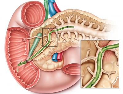 причины образования взвеси в желчном пузыре причины образования взвеси в желчном пузыре