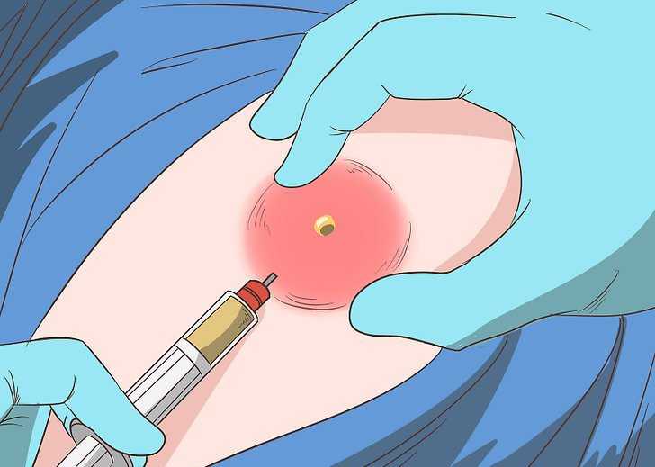 Фурункул, карбункул и абсцесс кожи - лечение