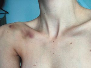 Ушиб ключицы: симптомы и лечение в домашних условиях