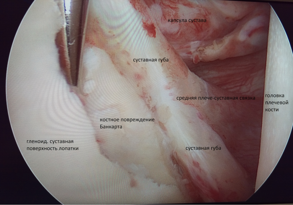 Тендинит плечевого сустава: симптомы и лечение тендинита сухожилий надостной, двуглавой мышцы плеча