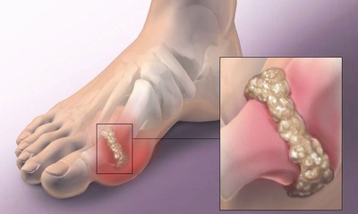 Минеральная вода при подагре: чем полезна, какую можно пить для лечения - список марок, а также, какие имеются противопоказания