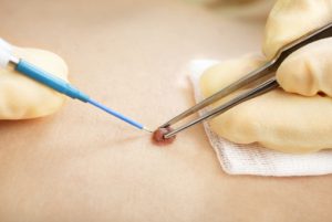 Удаление папилломы подготовка Удаление папилломы подготовка