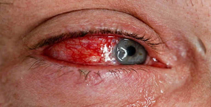 ультрафиолетовый кератит