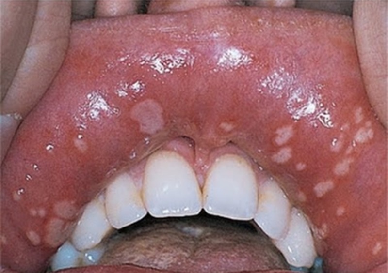 Герпетиформная форма афтоза