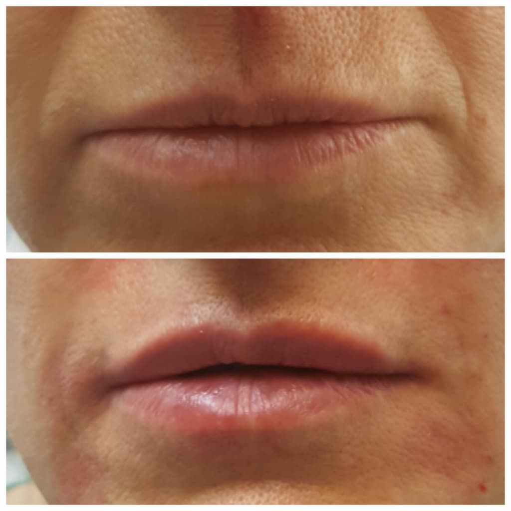 oslozhnenija-posle-konturnoj-plastiki-gub-2