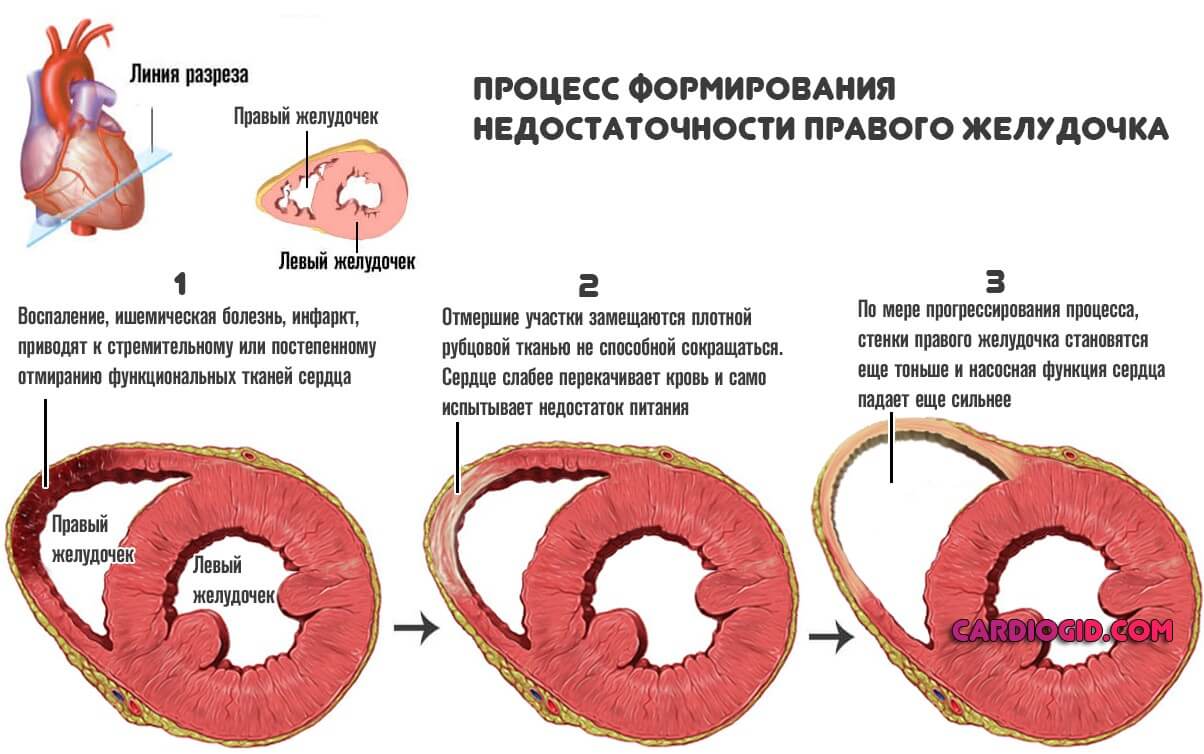 правожелудочковая недостаточность