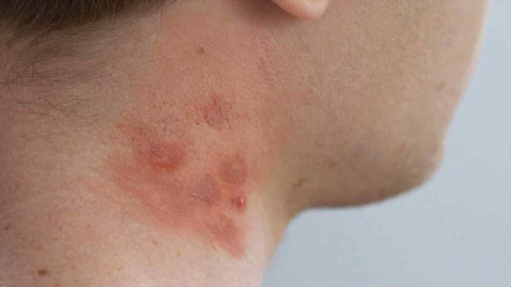 контактный дерматит