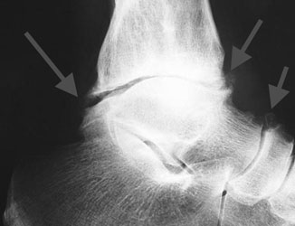 Остеофиты позвоночника: симптомы и методы лечения болезни