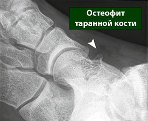 Остеофиты позвоночника: симптомы и методы лечения болезни