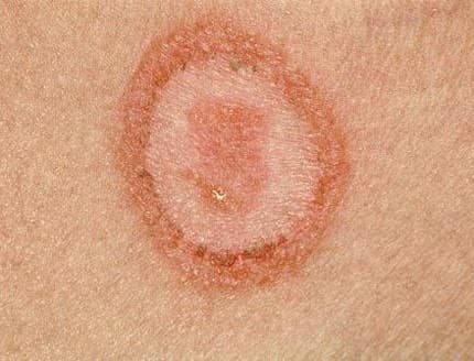 Грибковое заболевание