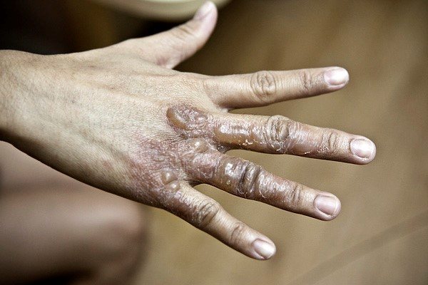 Симптомы ожога Димексидом и что делать