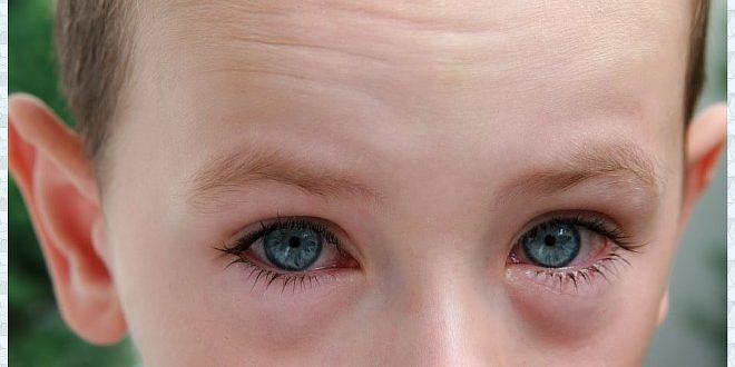 Аллергическая реакция