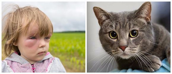 Анафилактическая реакция