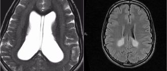 Лейкомалия мозга