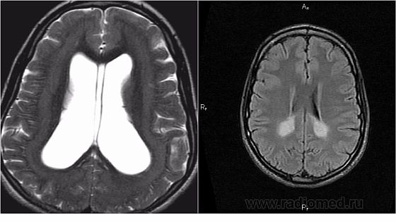 Лейкомалия мозга