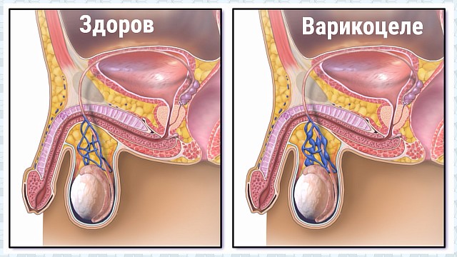 Стадии варикоцеле