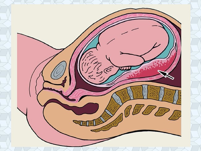 Гематома в матке