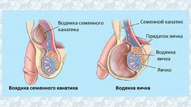 Гидроцеле яичка