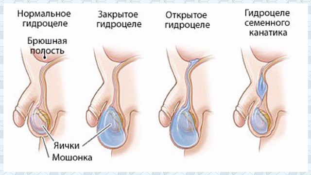 Диагностика гидроцеле