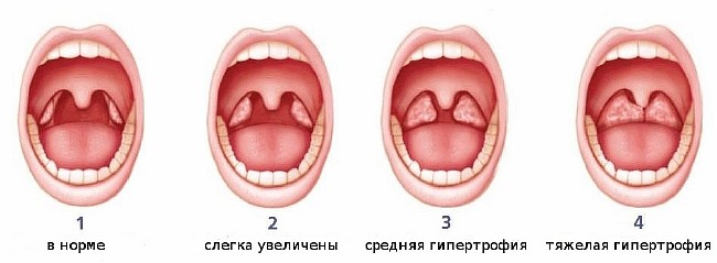 Аденоиды: причины, симптомы, лечение без операции