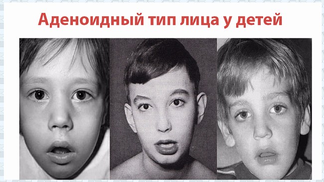 Аденоиды: причины, симптомы, лечение без операции