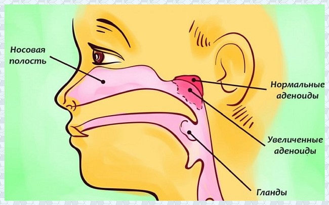 Аденоиды: причины, симптомы, лечение без операции