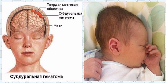Чем опасна гематома (шишка) на голове новорожденного