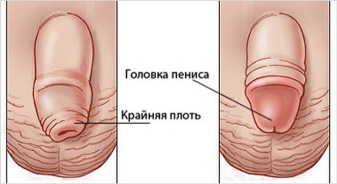 Что делать, если опухла головка и крайняя плоть