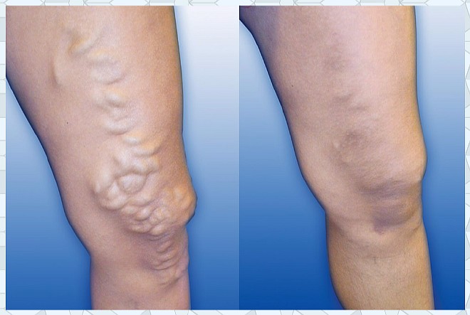 Лечение варикозного расширения ног