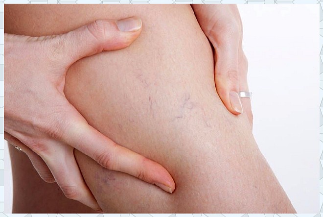 Лечение варикозного расширения ног