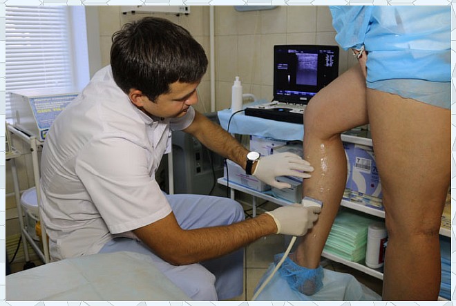 Лечение варикозного расширения ног