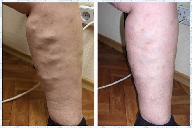 Лечение варикозного расширения ног