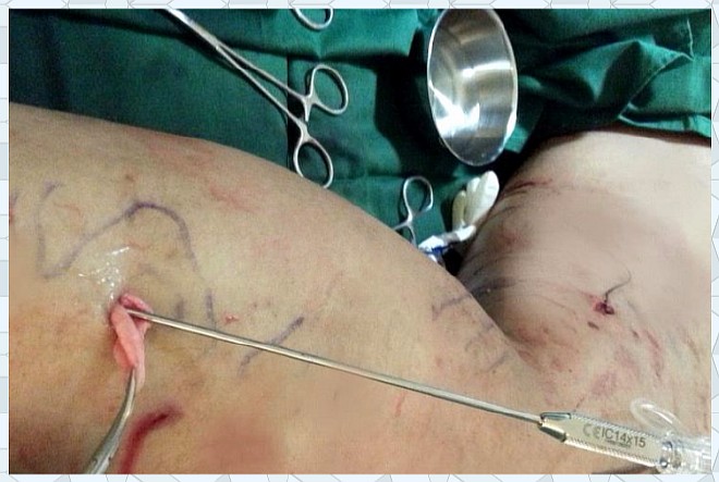 Лечение варикозного расширения ног