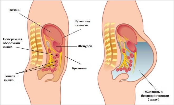 Жидкость в брюшной полости при раке - прогноз