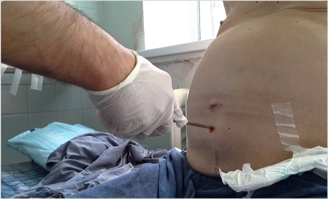 Жидкость в брюшной полости при раке - прогноз