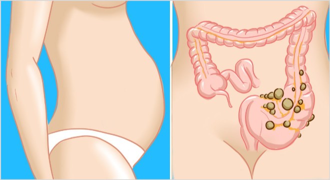 Жидкость в брюшной полости при раке - прогноз