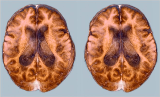 Отек головного мозга, как осложнение после инсульта